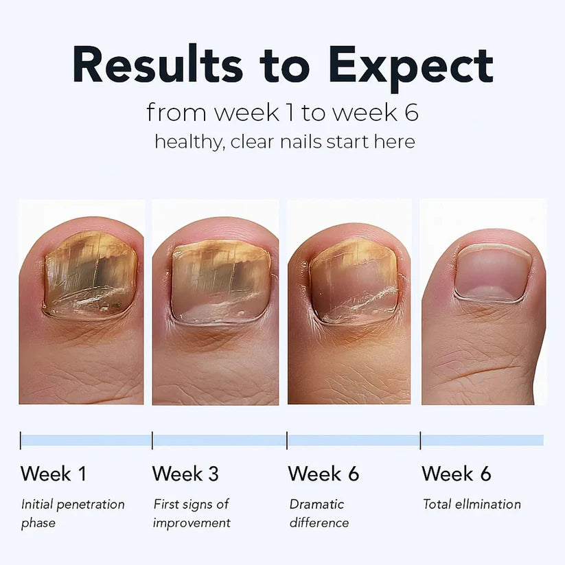 Newyuo® Fungal Nail Renewal Patches