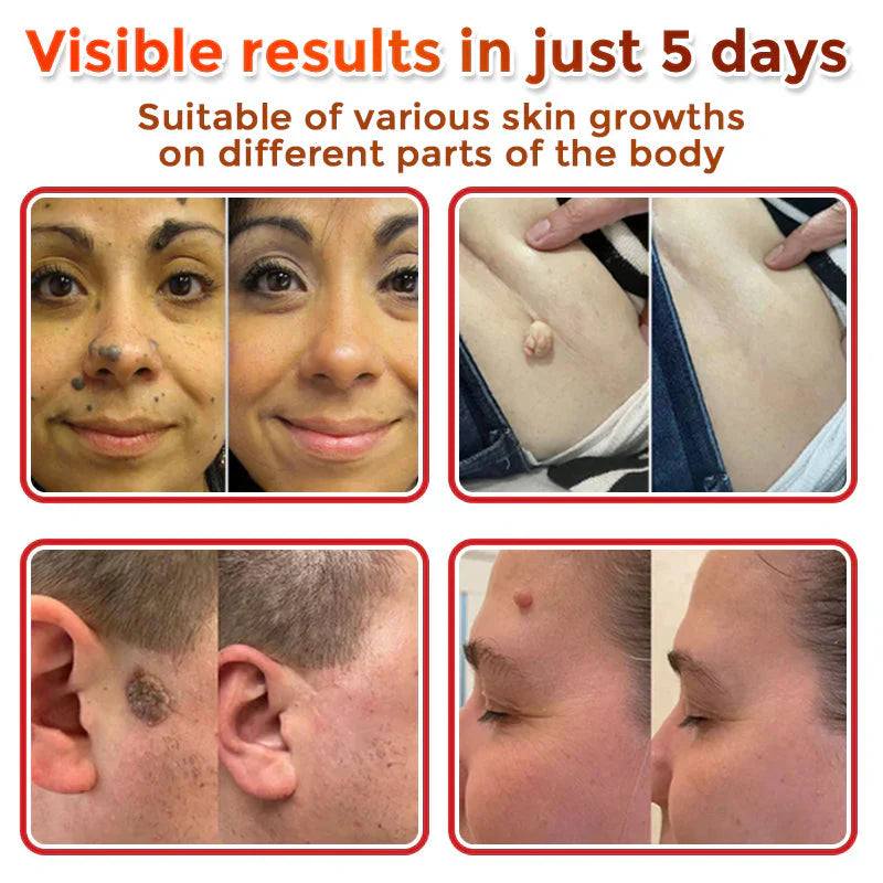 đLOVILDSÂź MicroNeedle Botanic Skin Tag Removal Patch (Made in the USA)