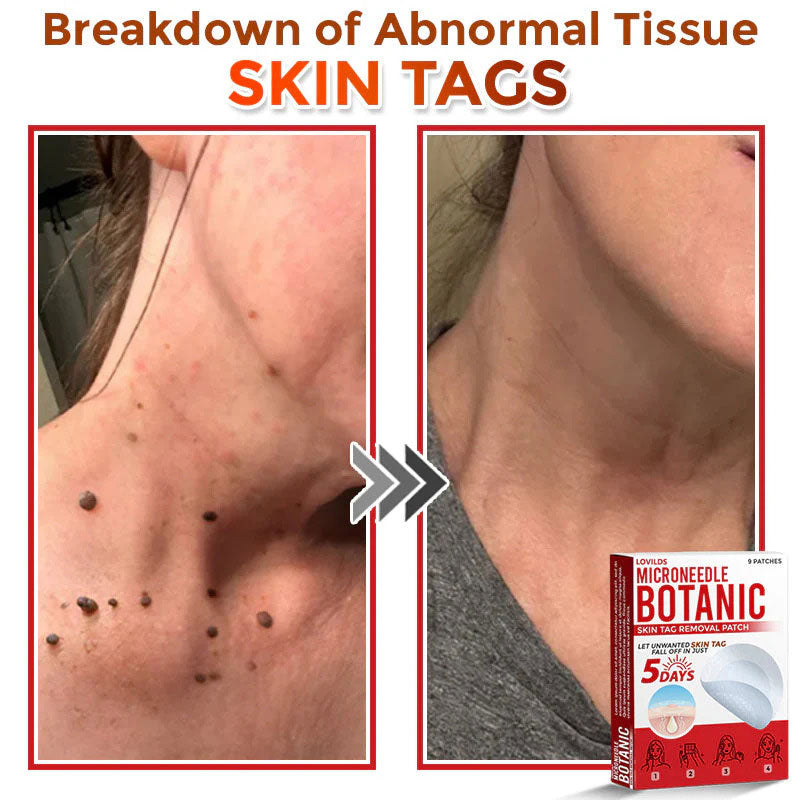 đLOVILDSÂź MicroNeedle Botanic Skin Tag Removal Patch (Made in the USA)