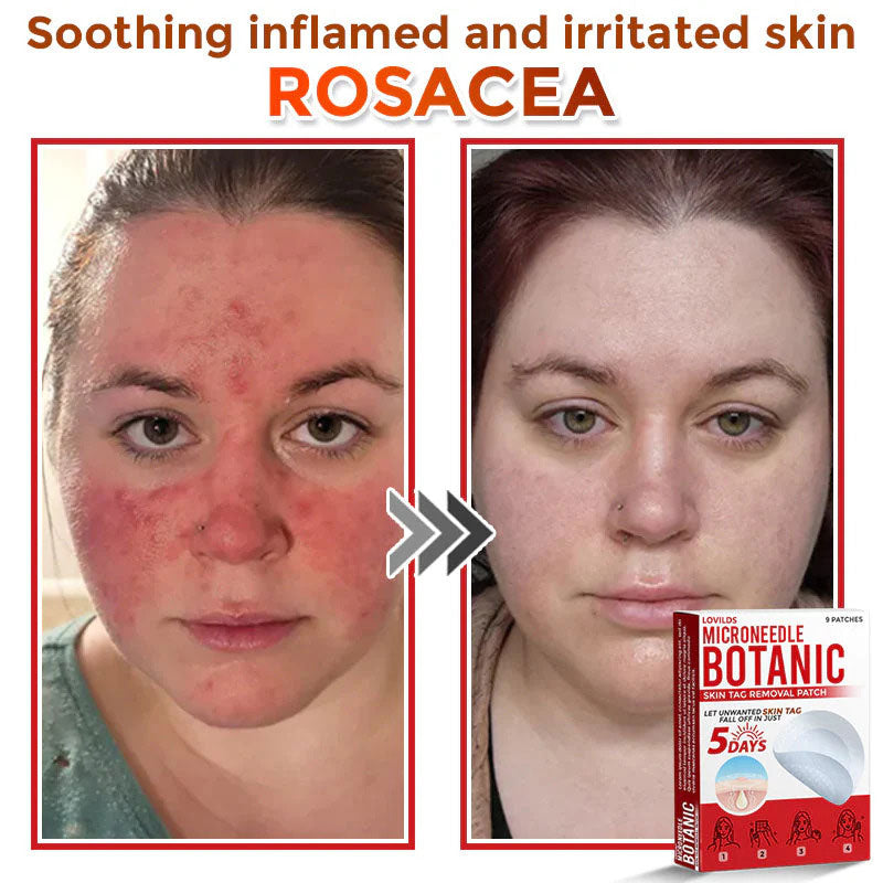 đLOVILDSÂź MicroNeedle Botanic Skin Tag Removal Patch (Made in the USA)