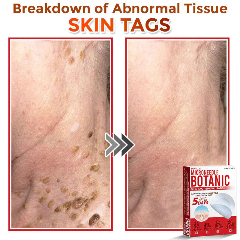 đLOVILDSÂź MicroNeedle Botanic Skin Tag Removal Patch (Made in the USA)