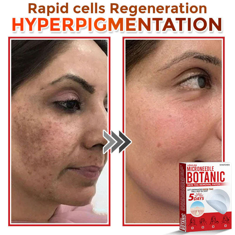 đLOVILDSÂź MicroNeedle Botanic Skin Tag Removal Patch (Made in the USA)