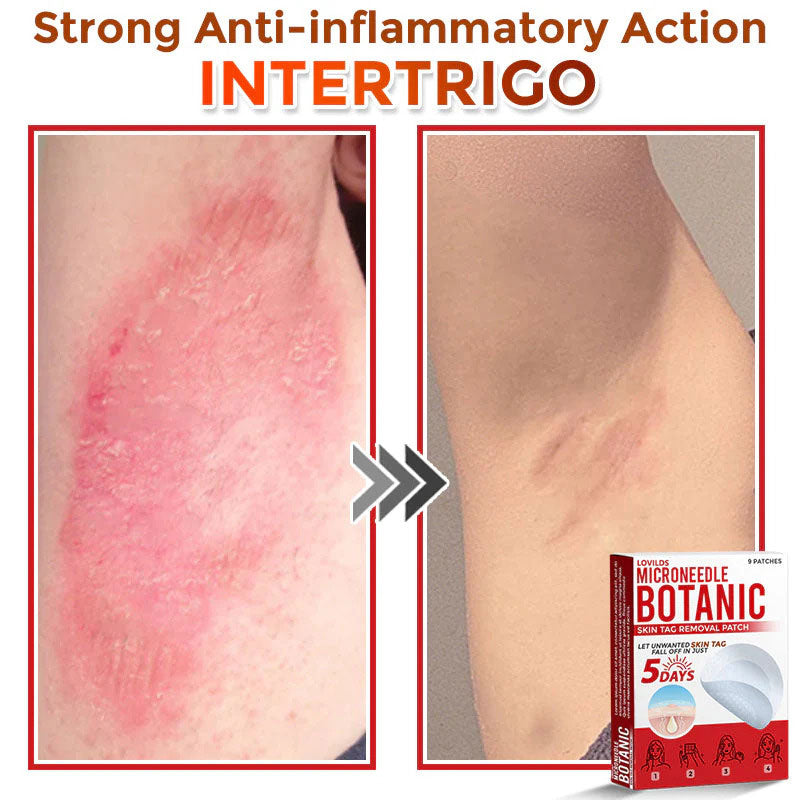 đLOVILDSÂź MicroNeedle Botanic Skin Tag Removal Patch (Made in the USA)