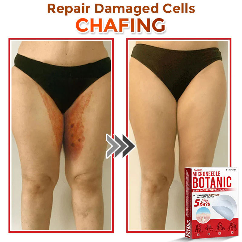 đLOVILDSÂź MicroNeedle Botanic Skin Tag Removal Patch (Made in the USA)