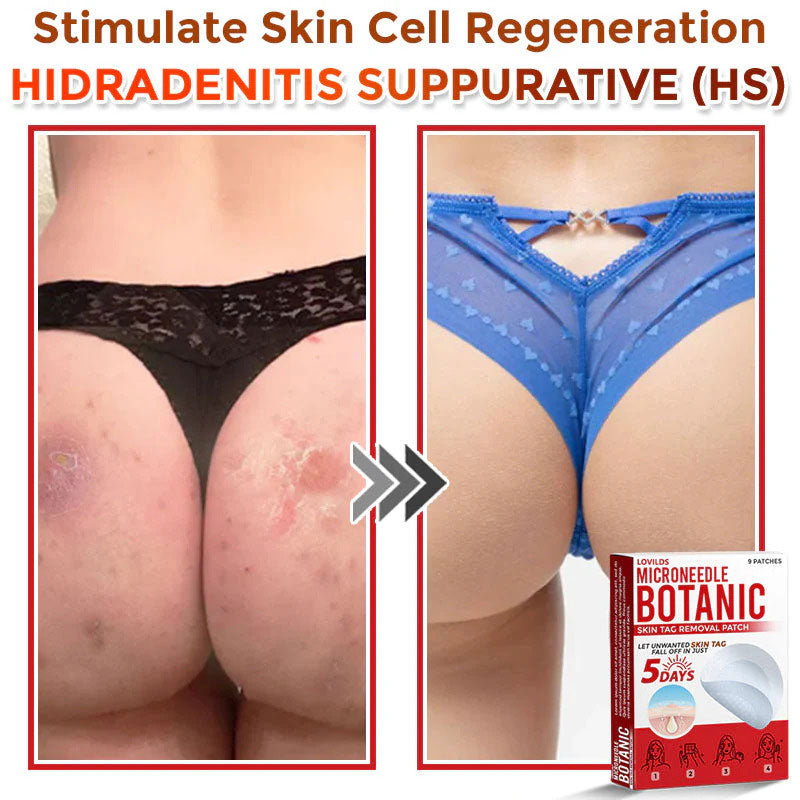 đLOVILDSÂź MicroNeedle Botanic Skin Tag Removal Patch (Made in the USA)