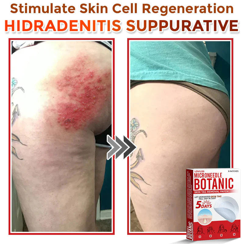 đLOVILDSÂź MicroNeedle Botanic Skin Tag Removal Patch (Made in the USA)
