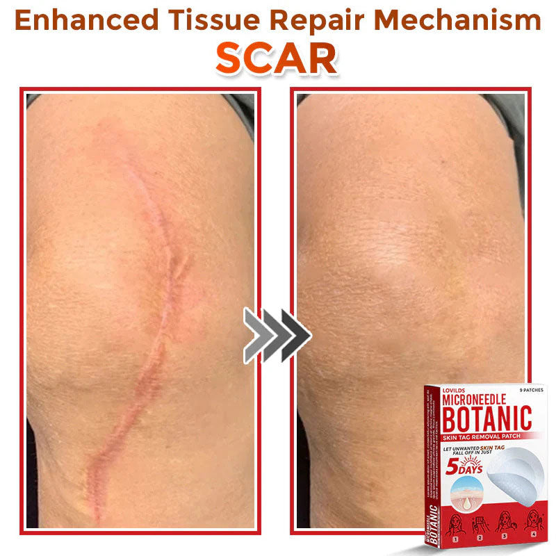 đLOVILDSÂź MicroNeedle Botanic Skin Tag Removal Patch (Made in the USA)