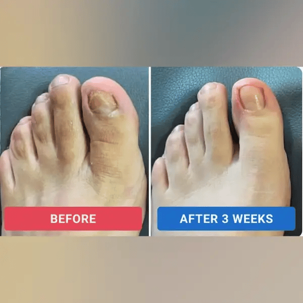 Newyuo® Fungal Nail Renewal Patches