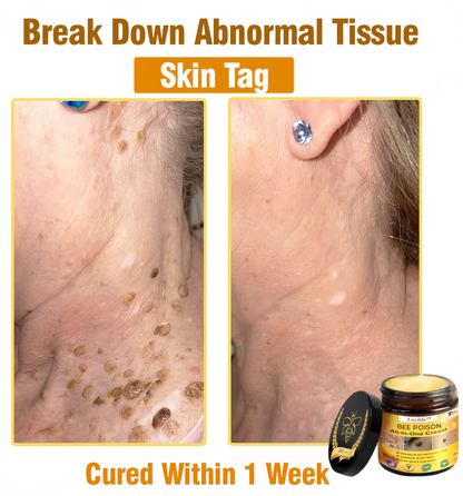 [Official Brand Store] 🏆Lovilds™ BEE POISON All-in-One Cream (✅FDA Approved & Mayo Clinic Recommended)