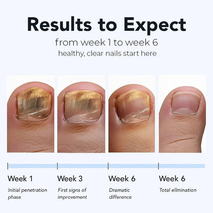 Newyuo® Fungal Nail Renewal Patches