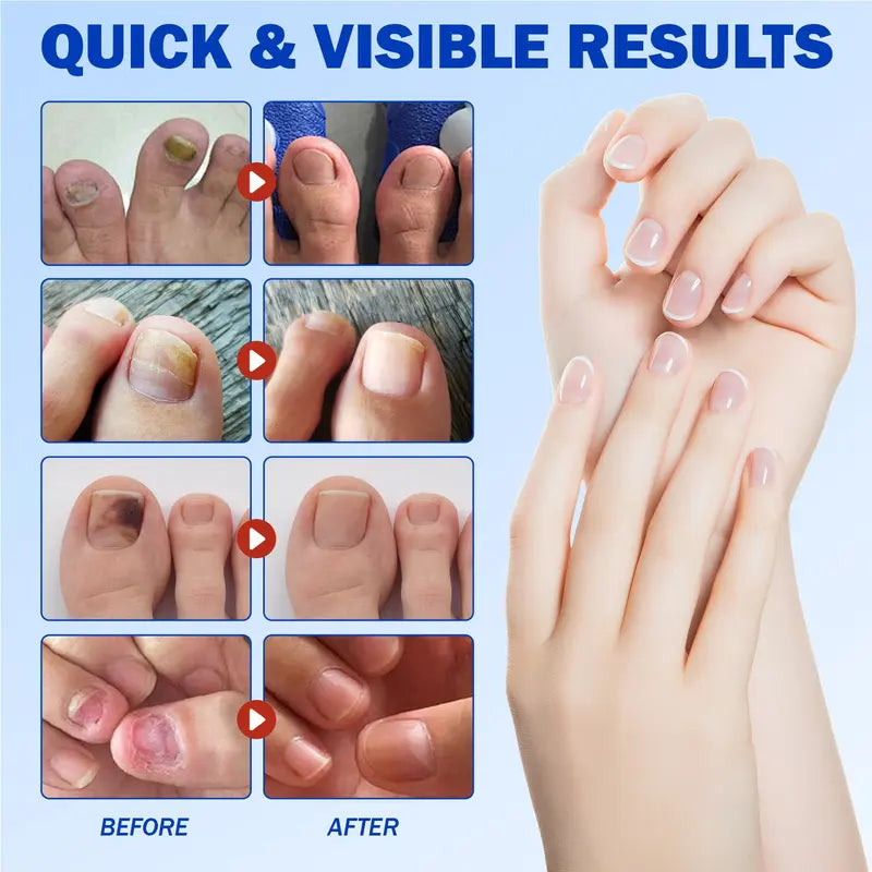 🔥Nail Health Care Patches – Repair and Strengthen Weak Nails Up to 65% OFF!