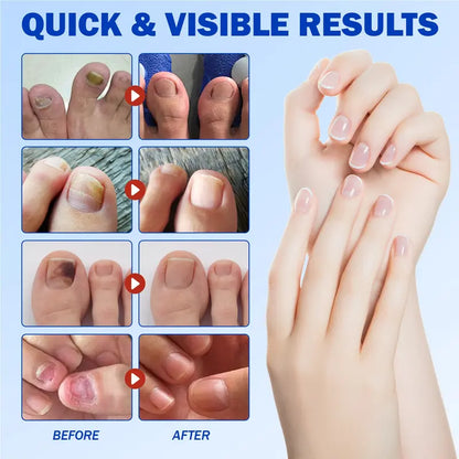 🔥Nail Health Care Patches – Repair and Strengthen Weak Nails Up to 65% OFF!